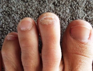 missing toenails